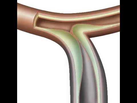 Video: Hvordan forhindre blodpropp (med bilder)