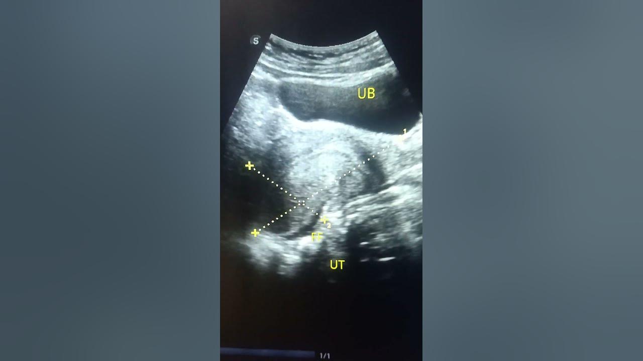 usg-video-s-bulky-uterus-with-rpoc-collection-and-pod-and-right