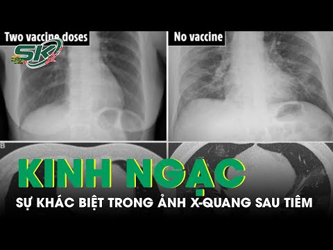 Kinh Ngạc Phát Hiện Sự Khác Biệt Trong Ảnh X-Quang Của Người Tiêm Vaccine Và Người Chưa Tiêm