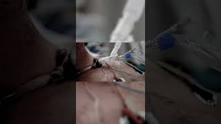 Tracheostomy Explain in 1 minute