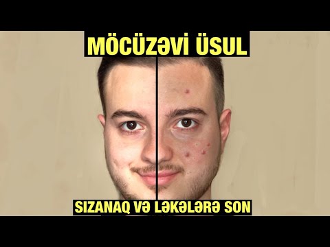 ÜZDƏKİ SIZANAĞLARI,GÜNƏŞ VƏ SIZANAQ LƏKƏLƏRİNİ ARADAN QALDIRMAQ ÜÇÜN SADƏ VƏ ASAN ÜSUL