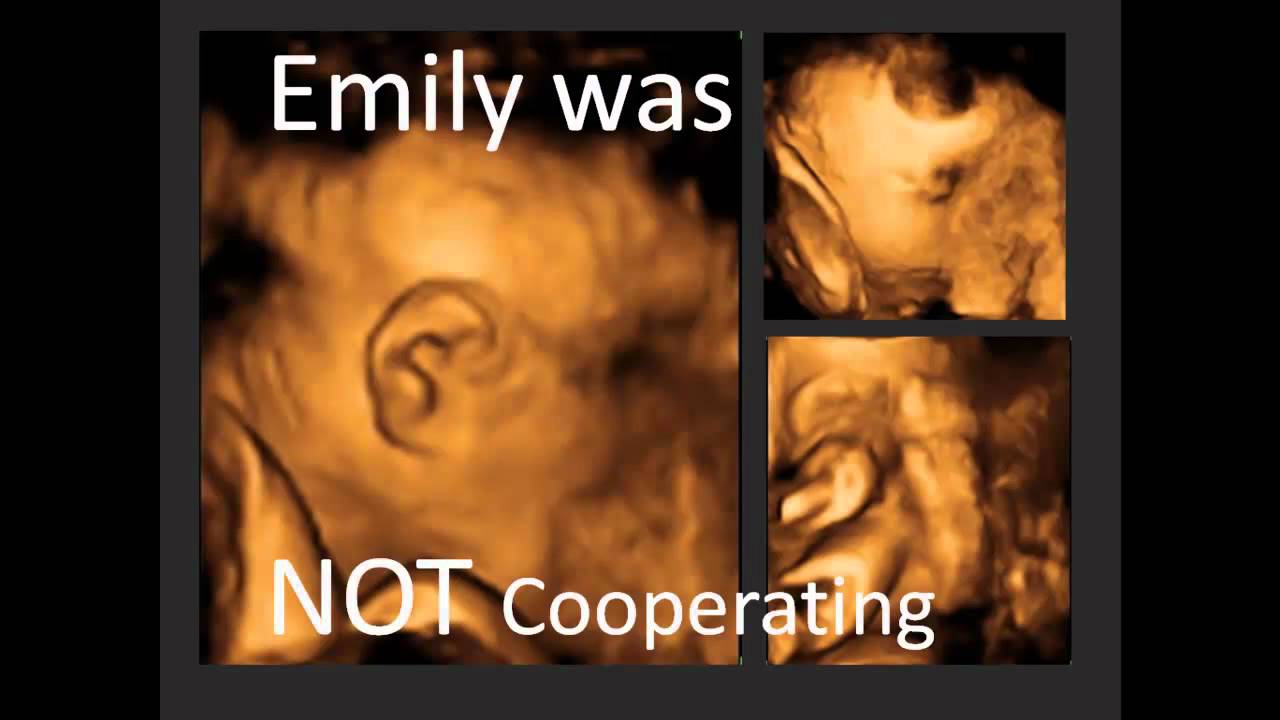 4D Ultrasound St. Lucie West Port St. Lucie 7722165445 New Life Imaging YouTube