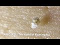 【No.11】巨大角栓引っこ抜く!Pull out a huge angle plug by tweezers.