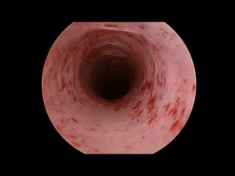 Video: Cystoscopy - Kontraindikasi, Akibatnya