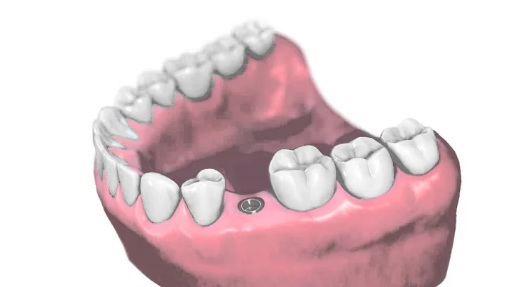 Single tooth