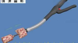 Intraluminal Circular Stapler for Surgery