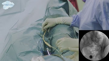 Retrograde placement of ureteral stent