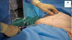 How is Liposuction done? (Live Surgery) | London Lipo Institute