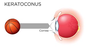 Warriors Stephen Curry Fixed His Vision - This Is What People With Keratoconus See