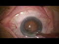 Chirurgie cataracte  phacoemulsification en cracking