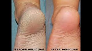 The most incredible Pedicure Transformation