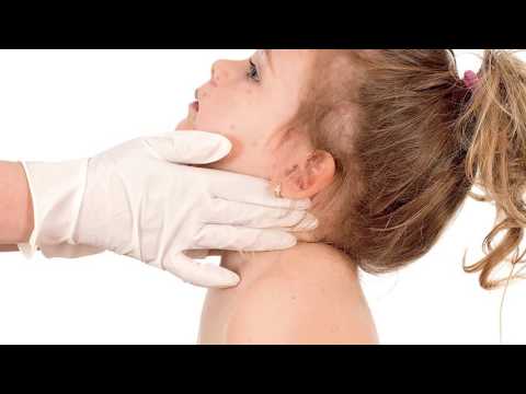Video: Masalas - Simptomi, Vakcinācija, Slimības ārstēšana