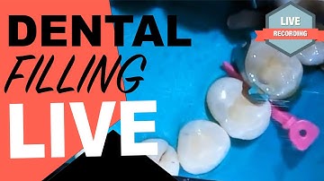 Class II Composite Filling | Dental Filling