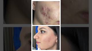 Kosmetoloq Dr Ayten Seyidova - Uz Temizlenmesi