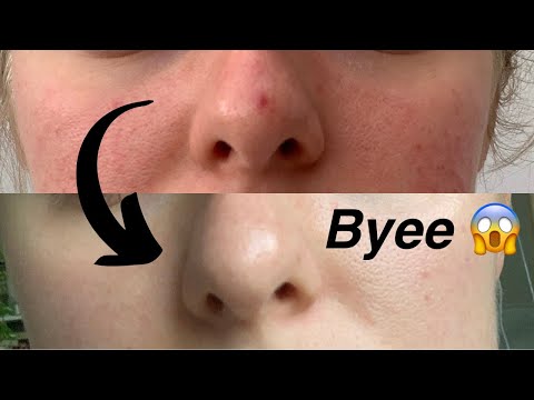 Video: Sådan Behandles Lav Rosacea Hos Et Barn