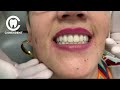 This dental prosthesis does not fall out of your mouth    prtesisdental  odontologia prtesis