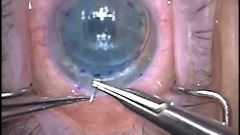 DMEK - Pearls for Success