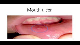 قرح الفم mouth ulcer  اسبابها وكيفيه علاجها