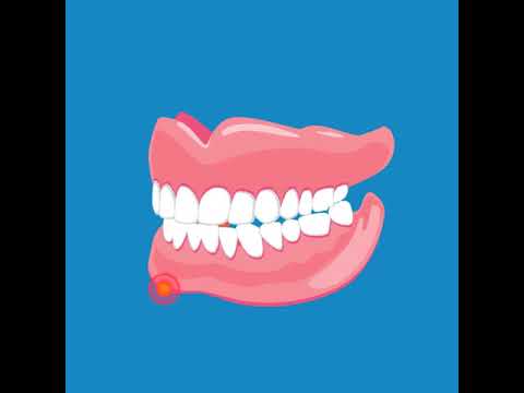 How to spot the signs of oral cancer 