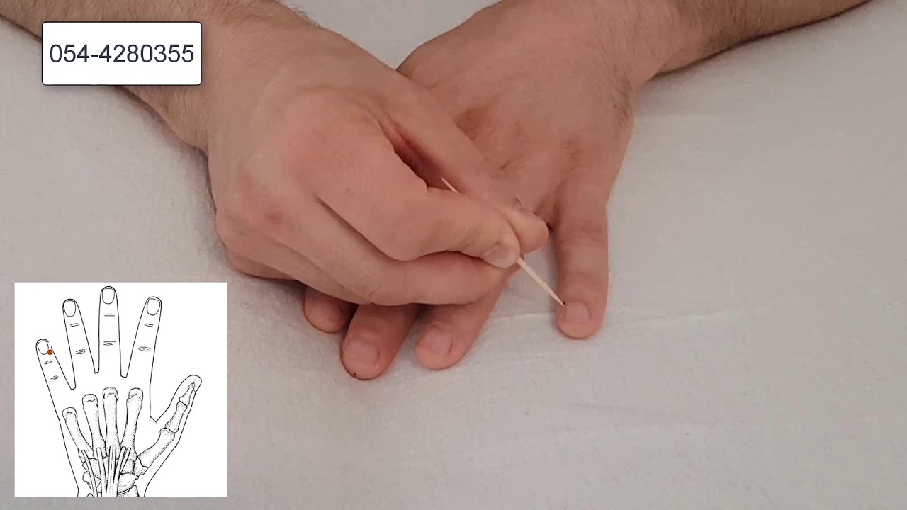 כאב ראש, מיגרנה - כך תטפלו בעצמכם בעזרת כמה לחיצות בכאב ראש בבית