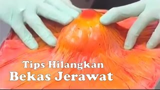 CARA MENGHILANGKAN BEKAS JERAWAT DALAM 3 HARI CUMAN 30RIBUAN AJA