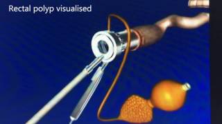 Transanal Endoscopic Micro-Surgery (TEMS) - English
