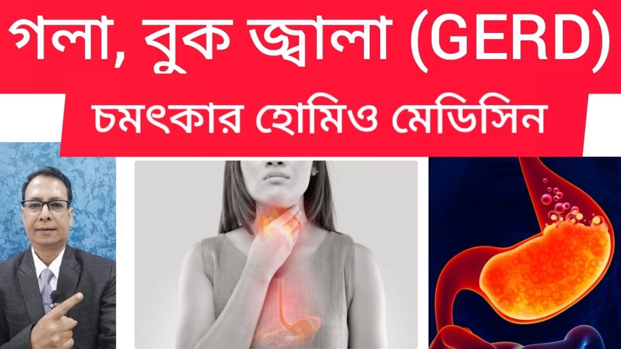 HEARTBURN (GERD) CURED BY HOMOEOPATHY/চমৎকার  হোমিওপ্যাথি ঔষধ গলা বুক জ্বলা এর জন্য (GERD)