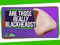 Are Those Really Blackheads?