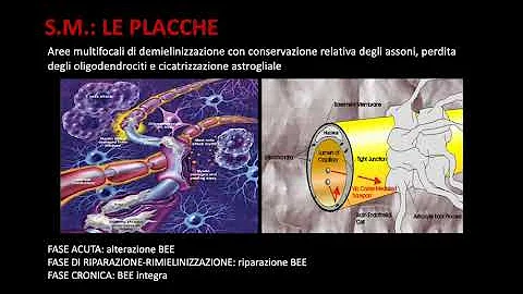 Quali sono le malattie demielinizzanti?