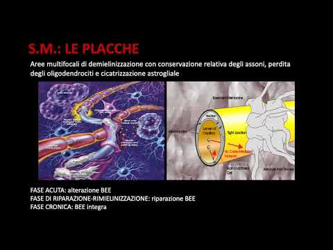 Video: Come curare la neurite ottica (con immagini)