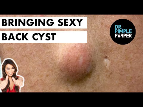 Bringing Sexy Back Cyst
