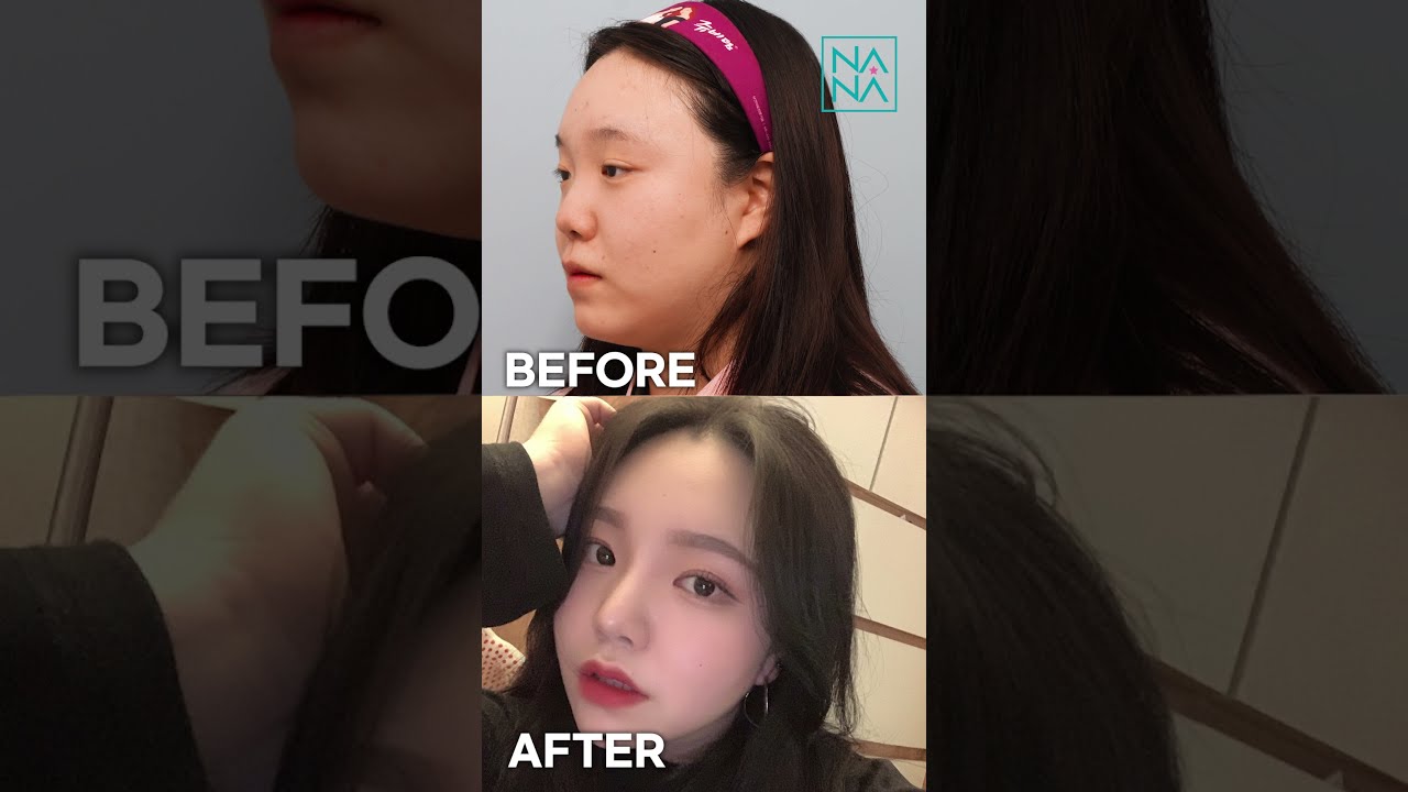 鼻整形ビフォーアフター団子鼻完璧改善 動画をご確認ください 韓国整形 韓国美容外科 Youtube