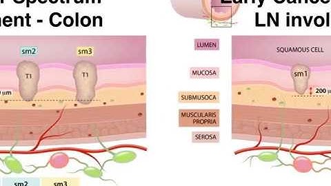 Colonoscopy: Colon Polyp Resection - EMR - ESD - Full thickness resection - SAGES-ASGE Meeting