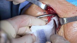 Open Inlay Bristow(CUIstow) Procedure with Button Fixation Preserving Capsule