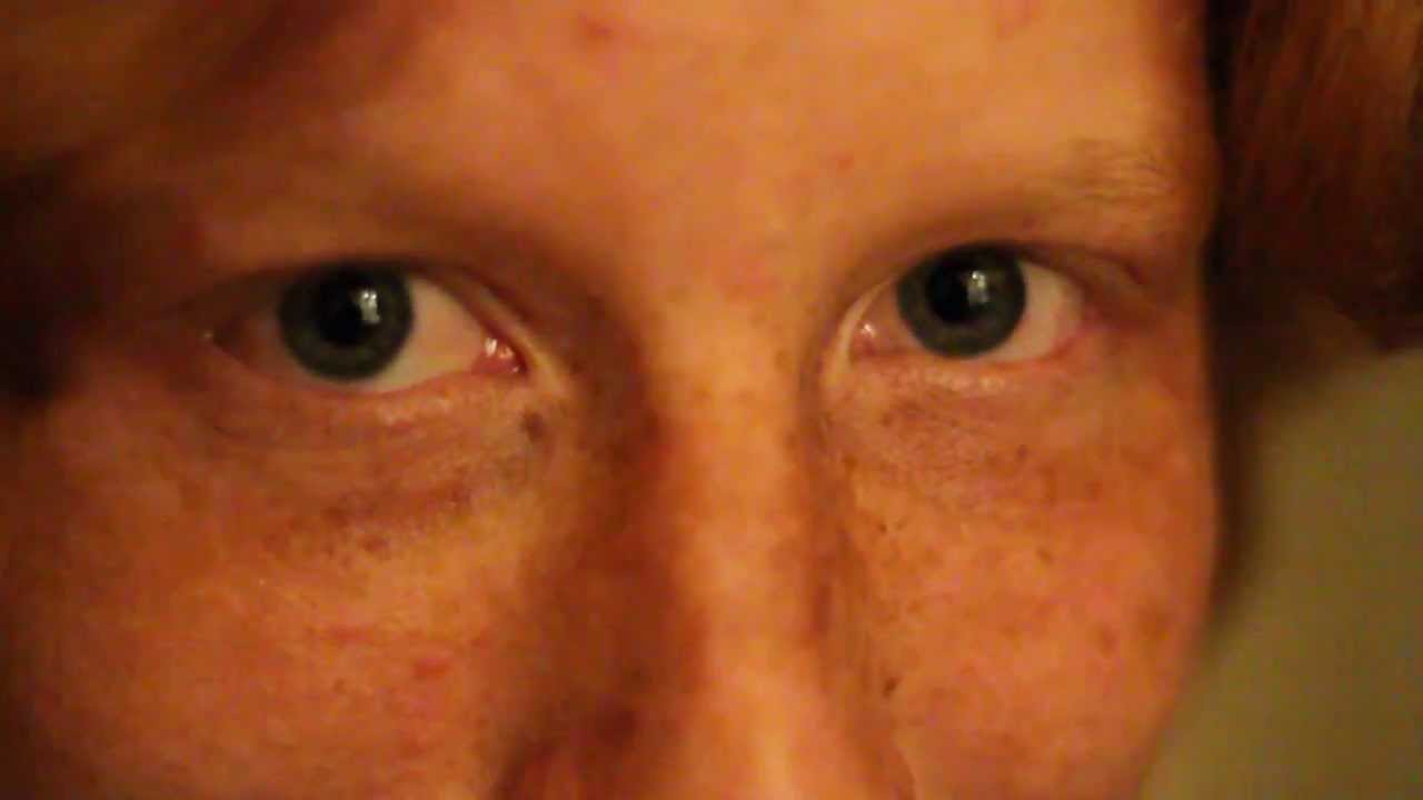 one pupil dilated one constricted one pupil dilated one constricted