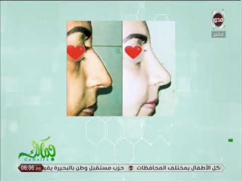 معلومات مهمة عن عمليات تجميل الأنف د محمد دنيا