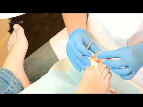 Video: Ingegroeide Teennagelchirurgie: Procedure En Nazorg