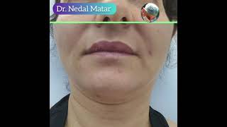 فيلر خطوط الحزن/ الابتسامة Nasolabial Filler