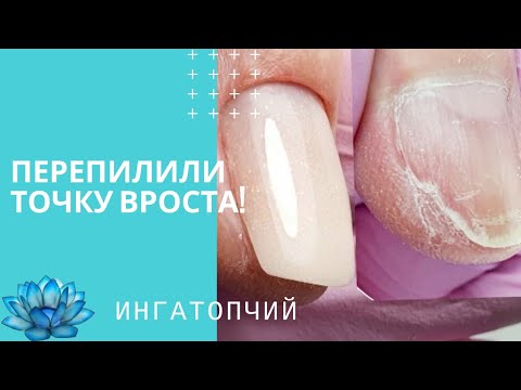 Точка вроста ногтя! Как восстановить. Ошибки в маникюре #10