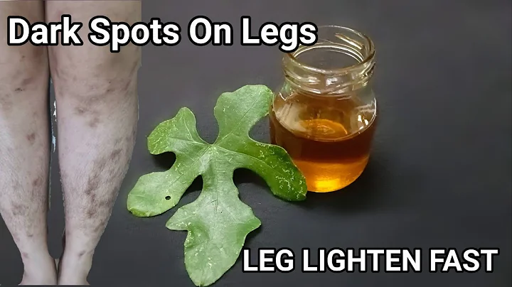 HOW MY LEG SCARS LIGHTEN FAST IN 2 DAYS SCAR,MOSQUITO, BITES ON LEGS WITH GOURD LEAVES.