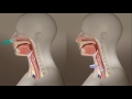 Tracheotomy Care: What Is A Tracheotomy