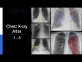 Chest X-ray Atlas #1 - 5