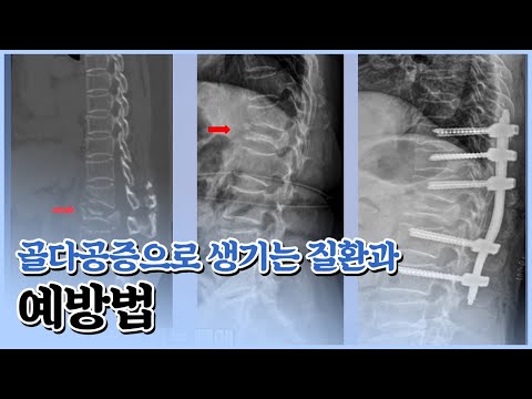 골다공증으로 생기는 질환들과 그 예방법