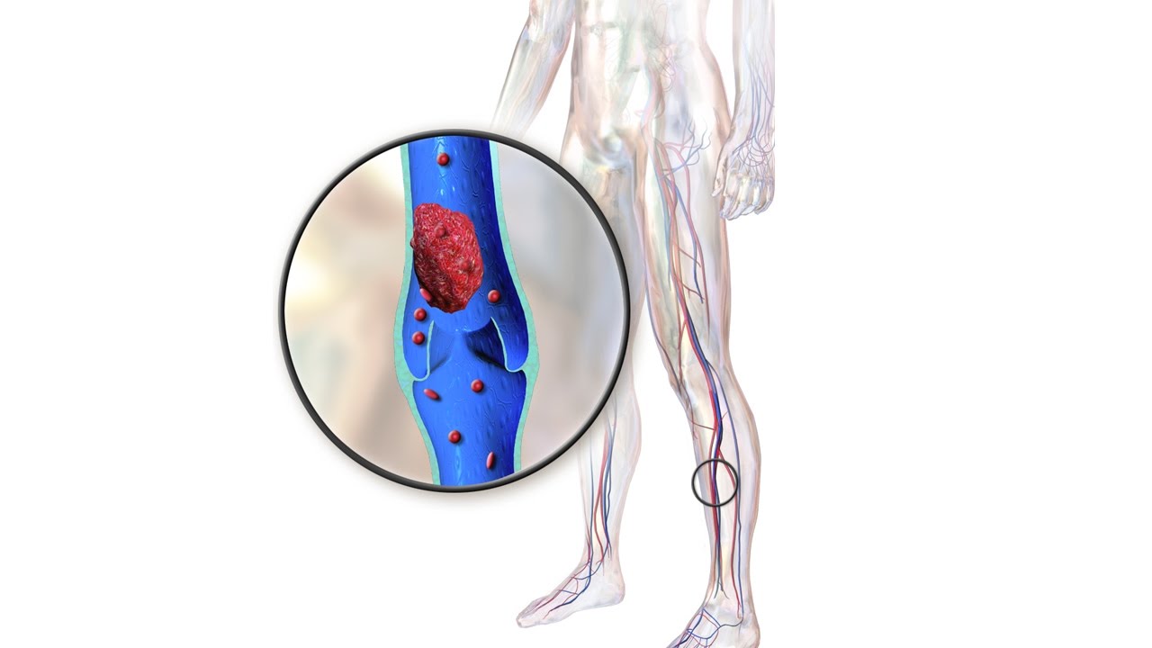 Тромбоз тэла. Тромбоэмболия вен нижних конечностей. Острый венозный тромбоз клиника. Подвздошно бедренный флеботромбоз. Острый флеботромбоз глубоких вен.