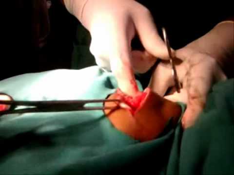 Multilobulated Lipoma excision under local anaesthesia father and son