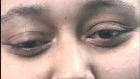 Aberrant third nerve regeneration - ophthalmology examination