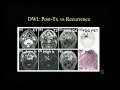 Imaging as a Prognostic Tool – MR Diffusion and Perfusion