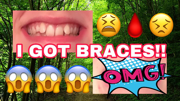I GOT BRACES!!!! - Casey Lowe