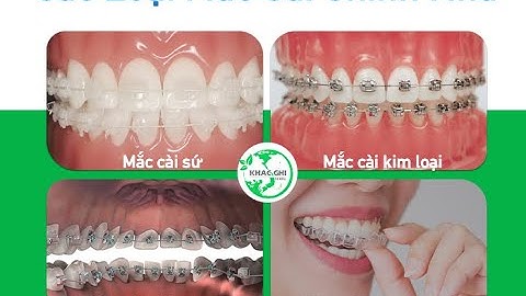 Niềng răng thay đổi hàm răng như thế nào?