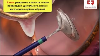 ДМПП у детей: операция эндоваскулярного закрытия дефекта межпредсердной перегородки окклюдером